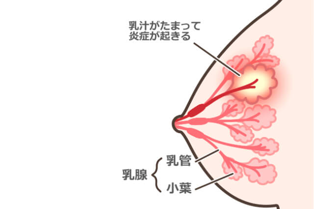 乳腺炎